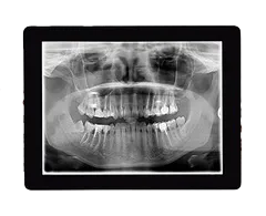 Digital X-rays